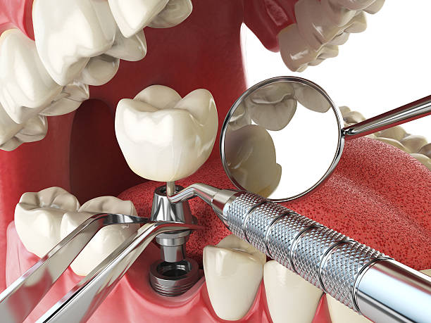 Best Urgent Care for Lost Fillings or Crowns in Springfield, GA